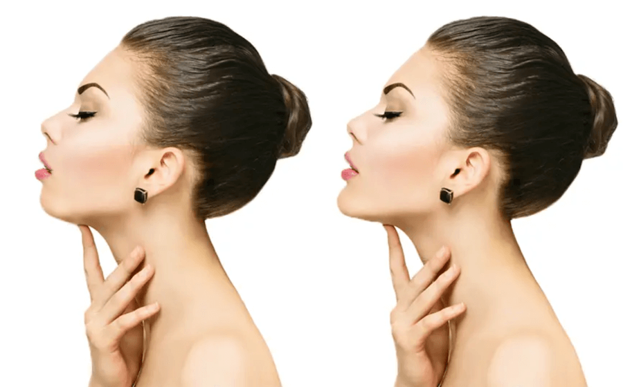 Jawline Uygulaması / Çene Hattı Uygulaması